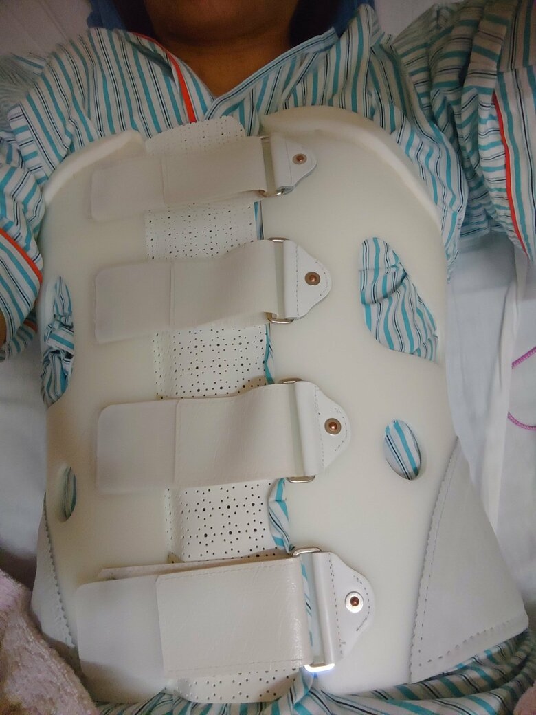 背骨を削ってボルトを入れる手術後、1年半もコルセット生活が続いた