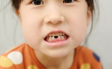 「永久歯が生えない子どもが増えている？」10人に1人は生えない驚きの事態「乳歯もいつか抜け落ちます」