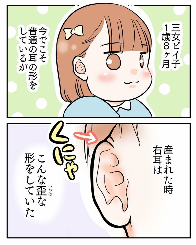 漫画「埋没耳治療しました」2