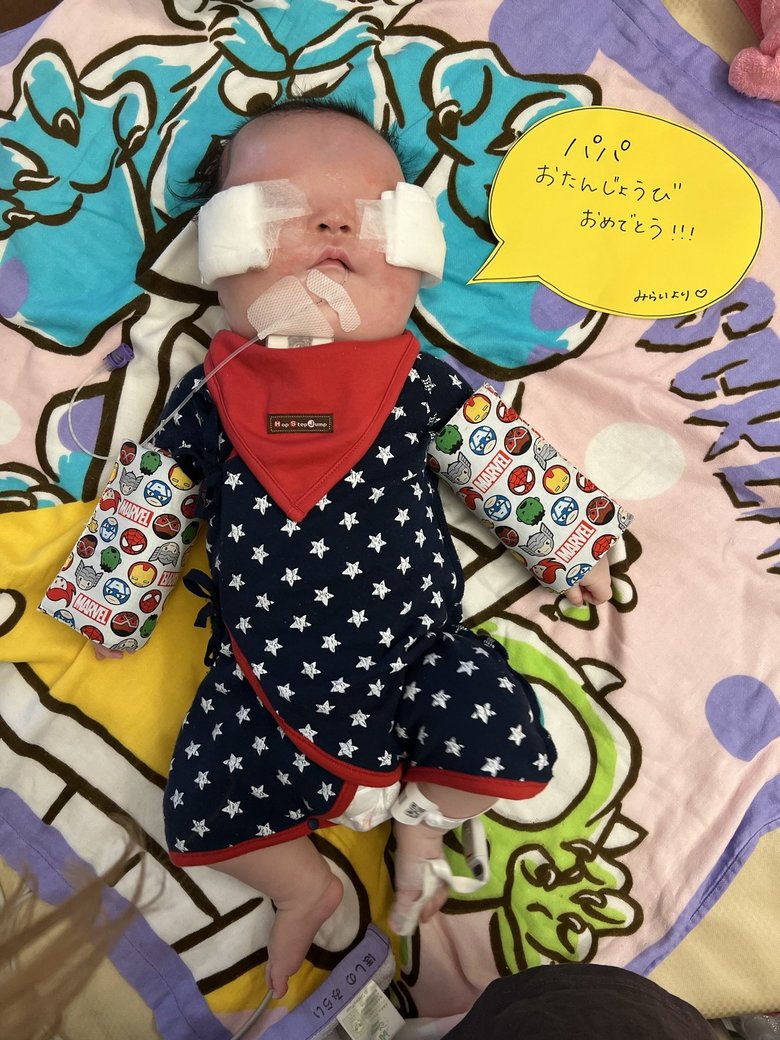 生後3か月。下瞼形成手術後