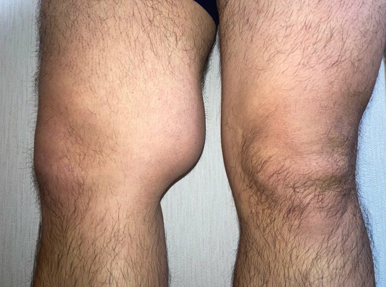 ひざ裏にこぶ状に盛り上がった悪性腫瘍