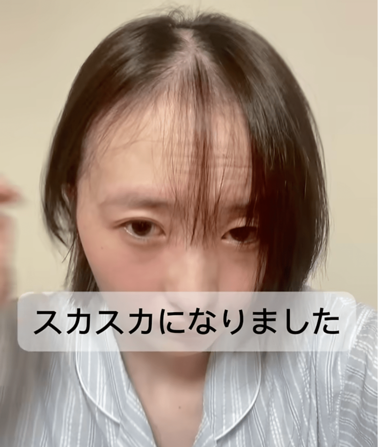 抗がん剤の副作用で髪が抜け始めたころ