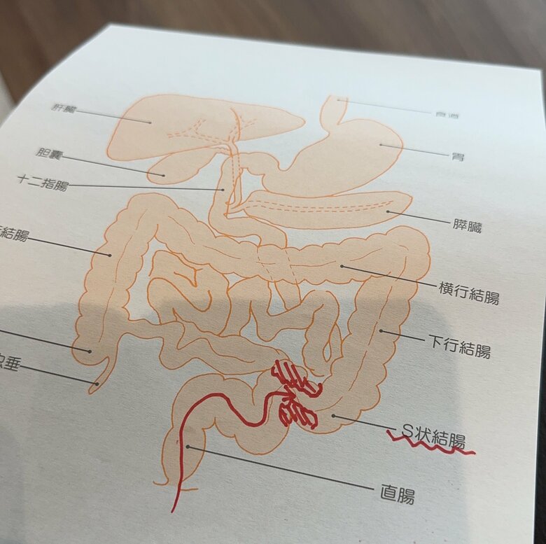 腸を塞ぐほどの大きさの腫瘍だったと説明を受けた