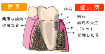 引用：日本臨床歯周病学会