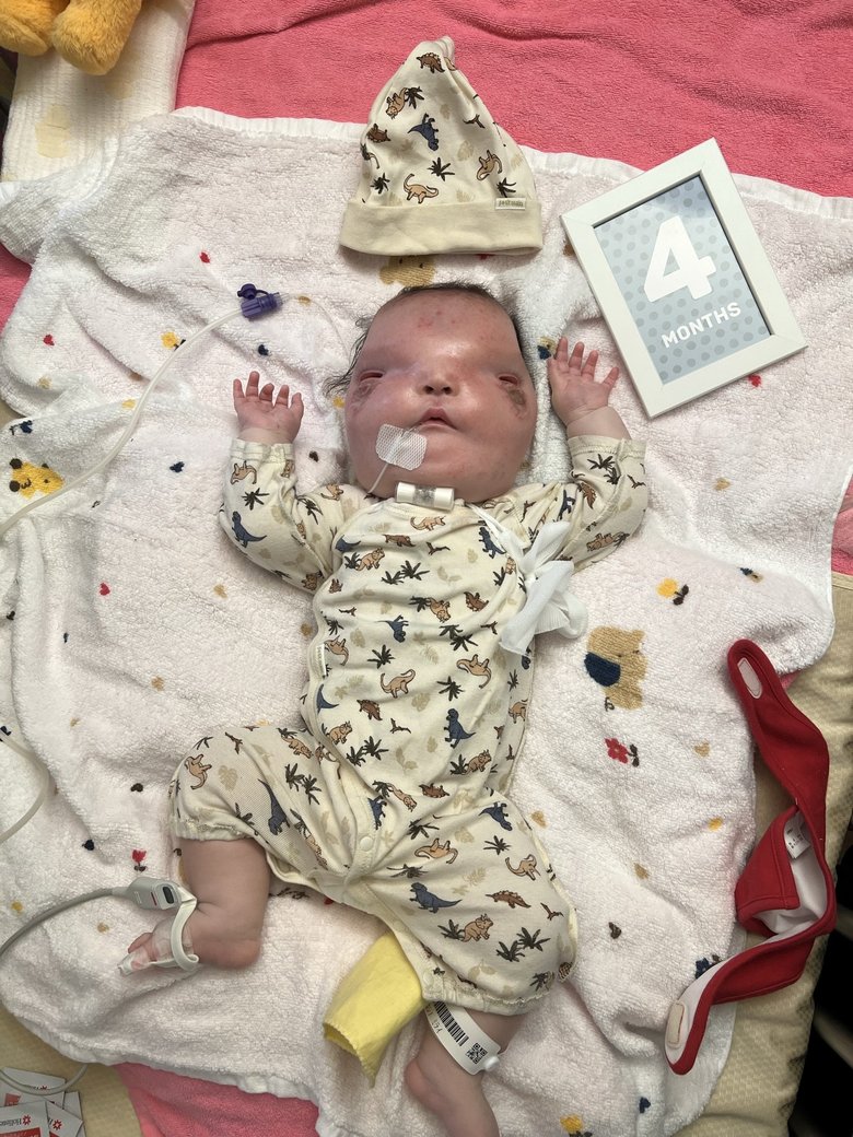 生後3か月。瞼を作ってからよく眠るように