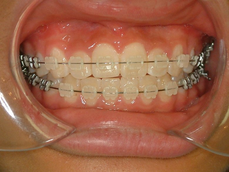 ▲「セラミック製」