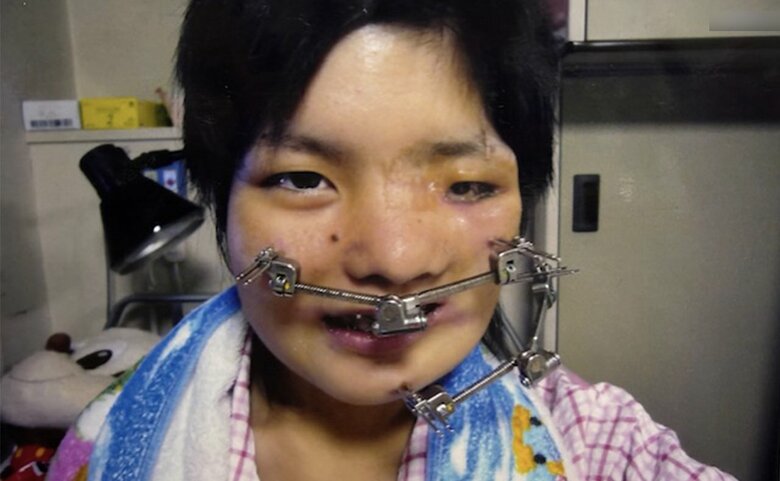 初めての手術で入院したとき