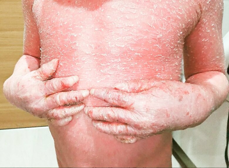 24時間かゆみに襲われる賀久くんの上半身