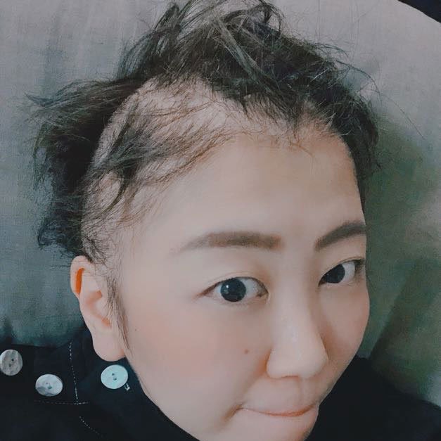 抗がん剤で髪の毛が抜けてきたころ