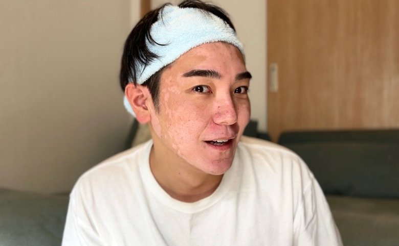 尋常性白斑で顔の色素が抜けた肌が