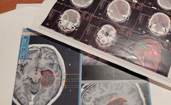 「突然キレる」「共感がない」脳腫瘍の術後に性格が変わった夫への「違和感」原因に気づくまで15年を要した妻の苦闘