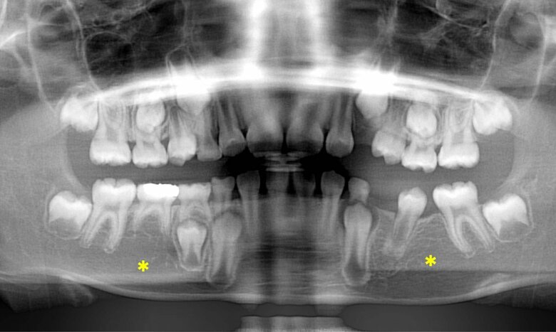 永久歯が欠損したレントゲン写真