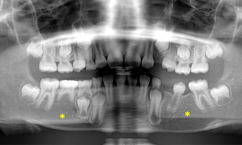 9歳女児。下あごの左右の第二小臼歯2本（＊印）が欠如している（写真提供／菊入 崇）