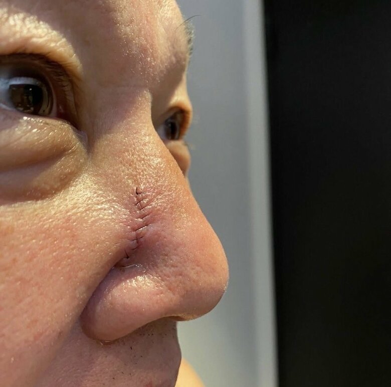 24年には鼻の脂肪種を切除。手術跡が痛々しい
