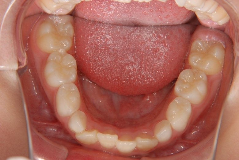  ▲前歯とその両サイドの乳臼歯の奥に生える大きな歯が「6歳臼歯」
