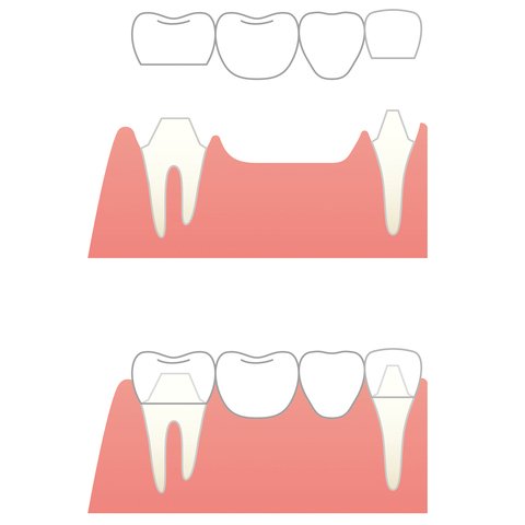 ブリッジ治療のイメージ