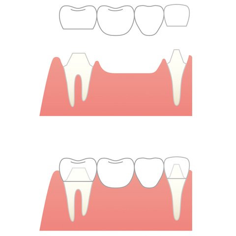 ブリッジ治療のイメージ。ブリッジは抜けた歯の両隣の歯を削り、人工歯をかぶせるもの