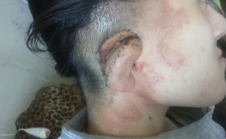 17歳。耳たぶをつくる手術を受けたとき