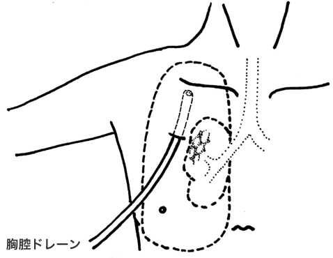 引用：慶應義塾大学病院呼吸器外科「気胸」