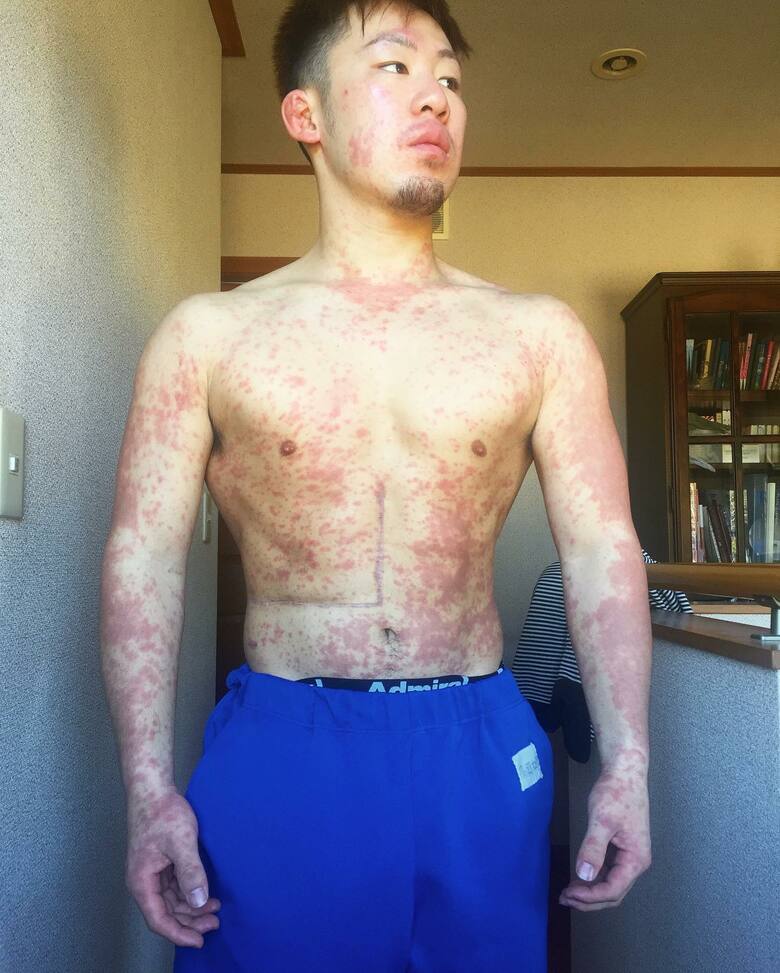 術後の後遺症に悩まされた