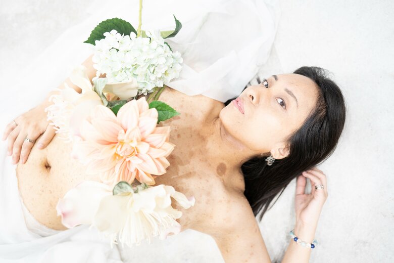 生まれつき全身にシミや腫瘍が広がる難病を抱える大河内愛美さん