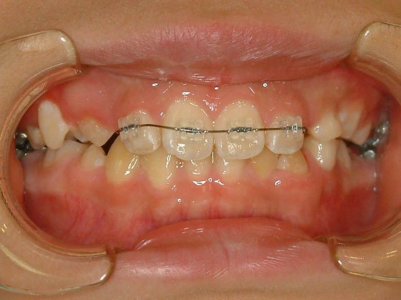 ▲「プラスチック製」