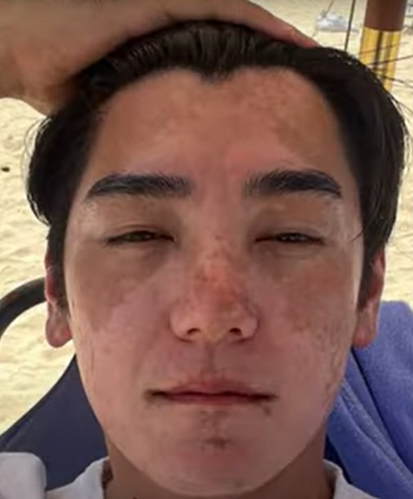 2024年6月。日焼けをして初めて、「これはおかしい」と病院へ