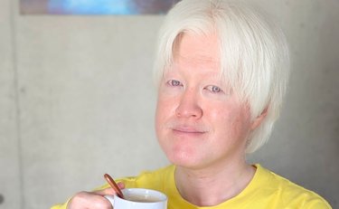 「どうして白いの？」同級生の質問に自分でも理由がわからず泣いた過去も アルビノ男性「母の言葉」で前向きに受け止めて