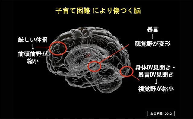友田明美, 『子どもの脳を傷つける親たち』（NHK出版）より