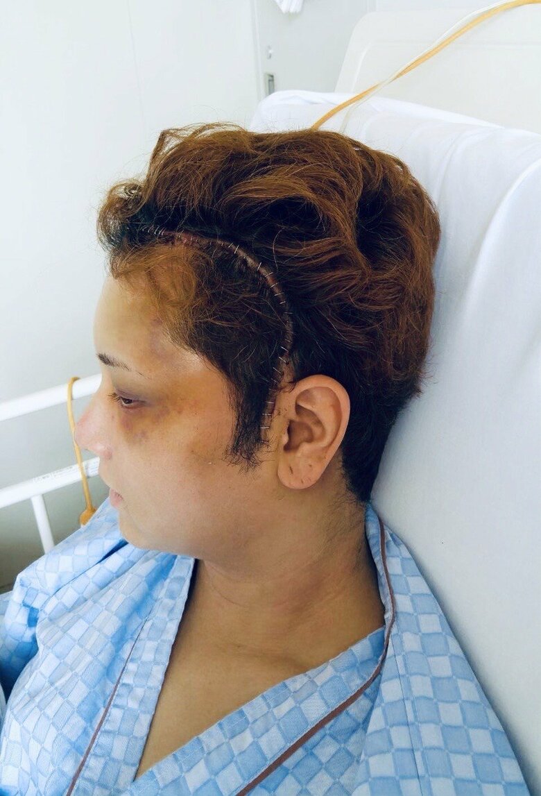 大手術だったことを物語る大きな傷跡