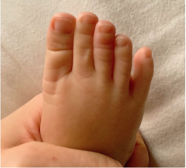 「ヘアターニケット症候群」から2週間後に撮影した写真 腫れの強かった中指も綺麗に回復した（21年9月 紺野あさ美さん撮影）