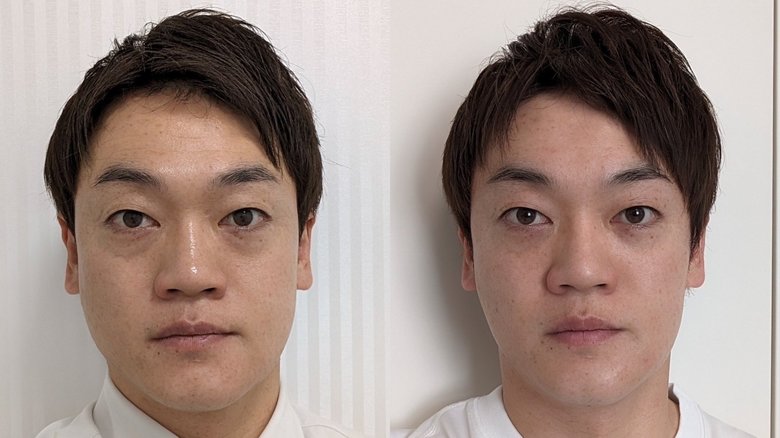 整形手術のビフォー（左）とアフター（右）