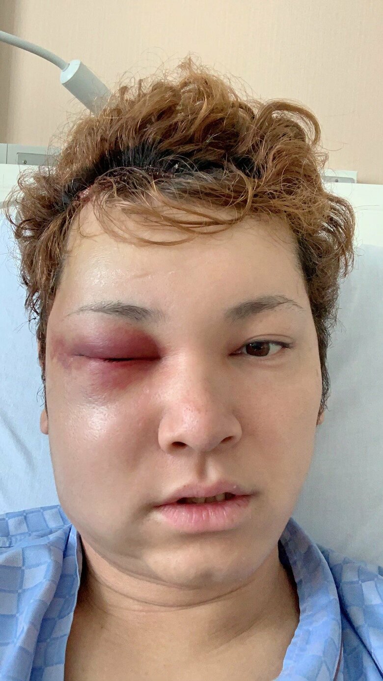 頬骨も外す大手術に