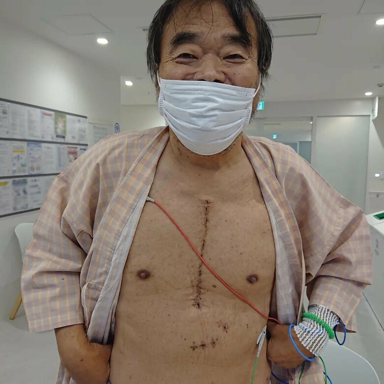 心筋梗塞の手術の傷跡が残る