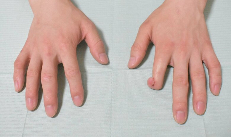 エピテーゼを装着する前の人差し指