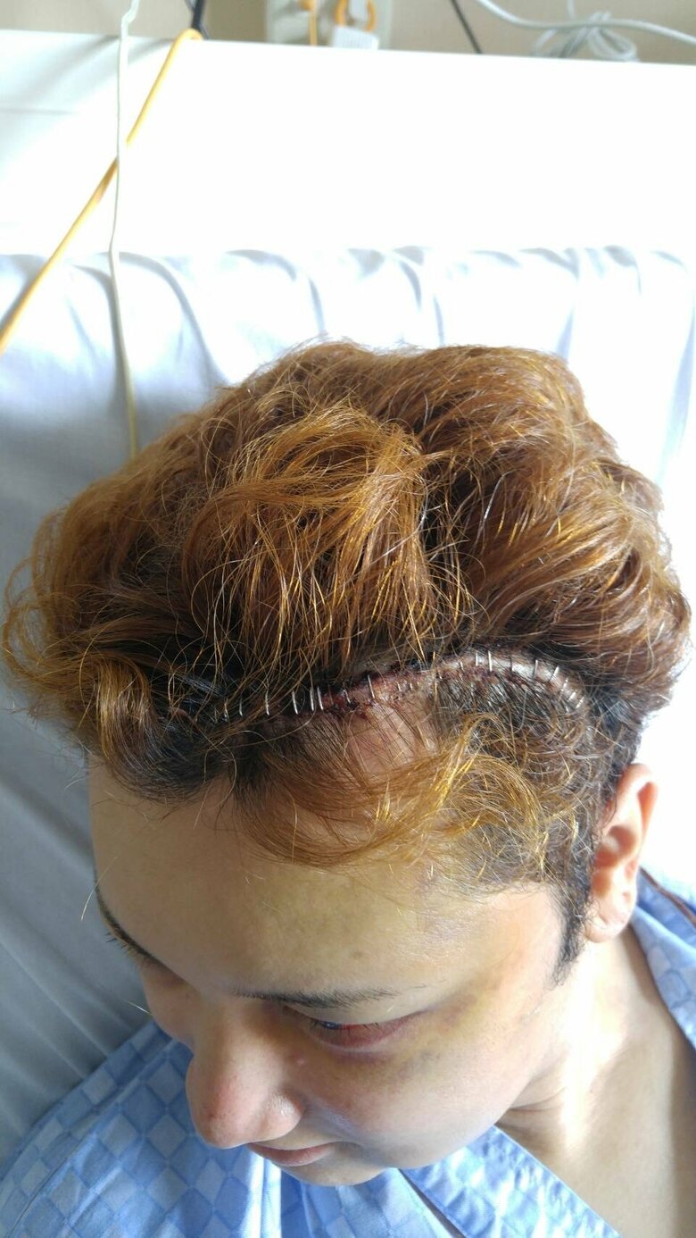 開頭手術の大きな傷跡が痛々しい