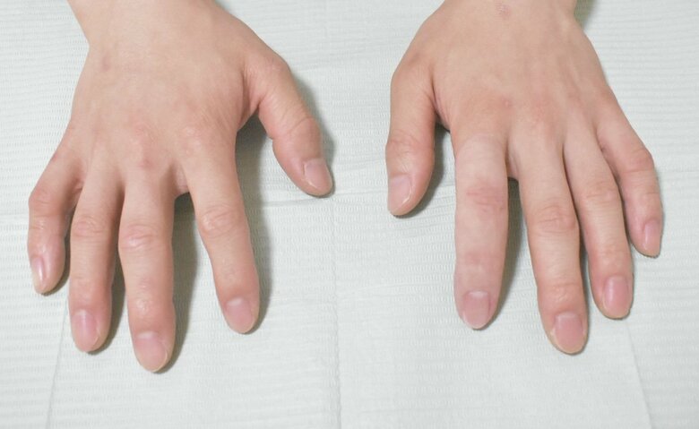 エピテーゼを装着した後の指。人差し指が短いことはまったくわからない