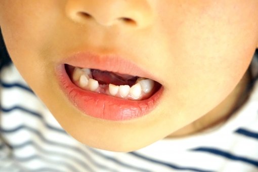 乳歯が生えている子どもの口元の画像
