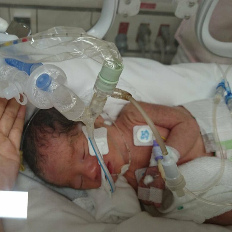 人工呼吸器をつけている生後1日目の息子さん