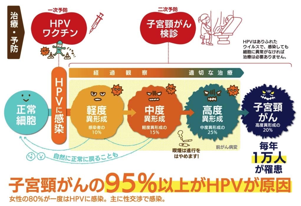 HPV感染から異形成子宮頸がんへの進行段階