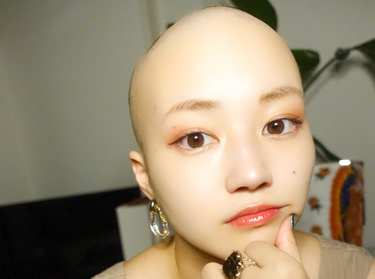 脱毛症に悩んだ20代女性の「スキンヘッド」動画が700万再生を超えた訳