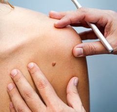 ホクロを切除した宮沢りえさんに「取りたい気持ちわかる」と共感の声続出！