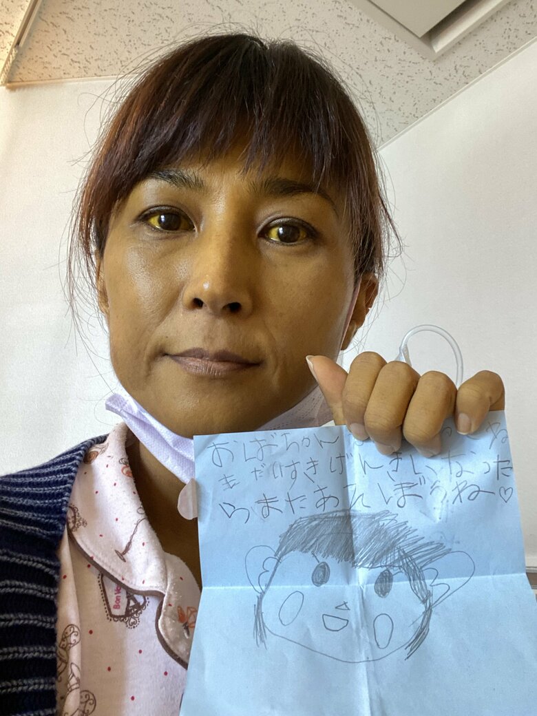 肝硬変末期。黄疸を通り越して顔が茶色く変色した