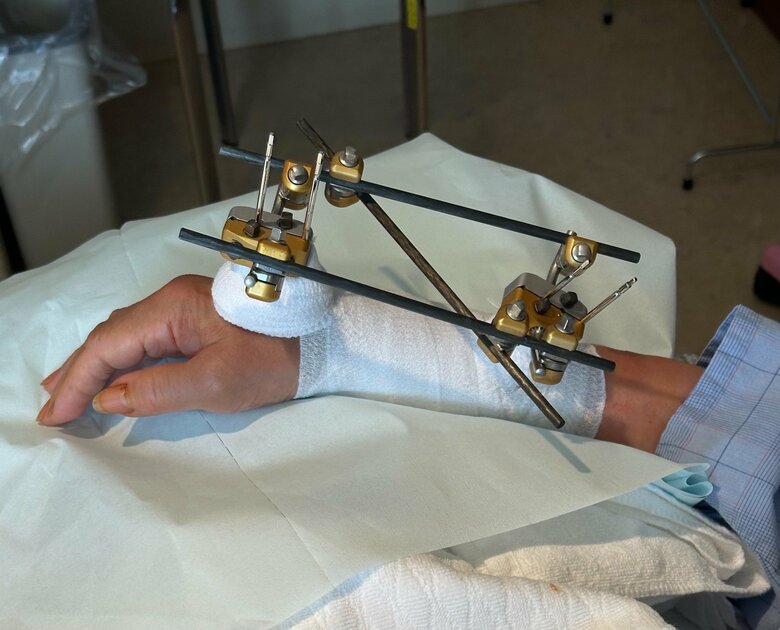 腕をケガし、ズレた骨を元の位置に戻すため器具を装着。この器具を外した後に2度目の手術でプレートをいれ10本のネジでとめた
