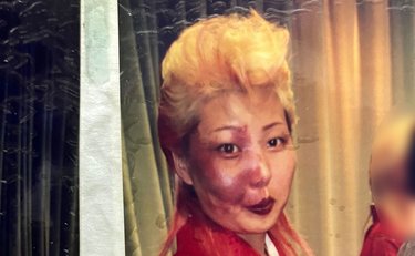 「電車に乗ると石を投げられ、唾を吐きかけられたことも」生まれつき顔にあざがある女性がそれでも自分の病気を実名で公表した訳