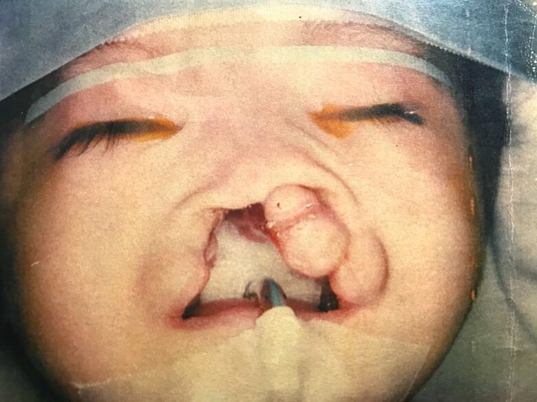 出生当時。どこが鼻でどこが唇なのかわからない状態だった