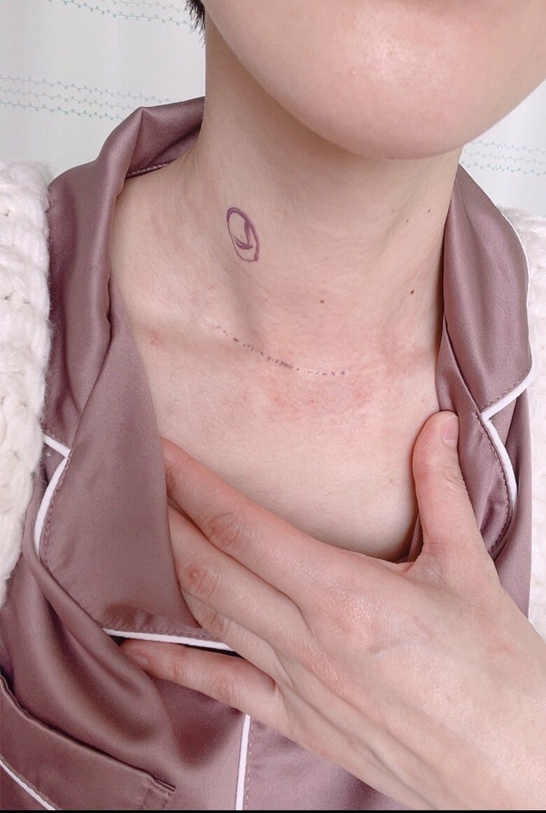 術直前、手術で切るところのマーク