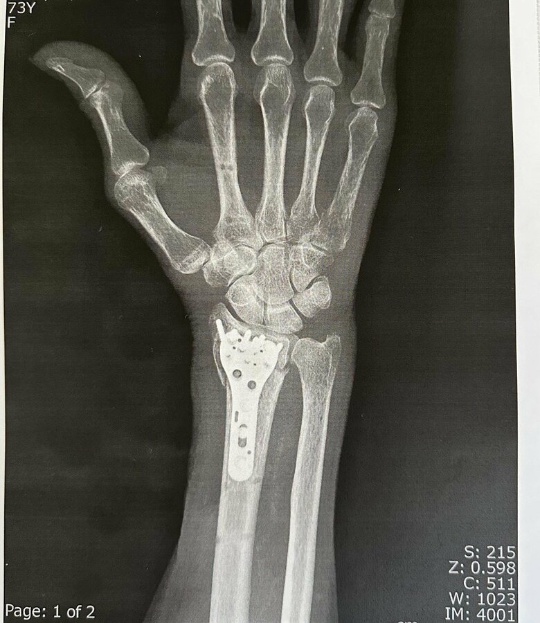 今年の春、転倒し大ケガ。腕をプレートで固定している様子が見て取れる