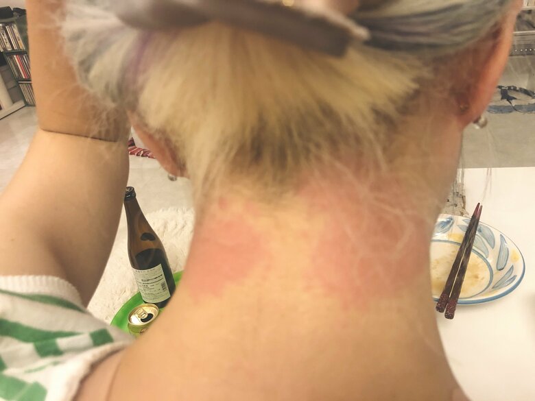 ブリーチ剤で髪が傷み、首にもかぶれが