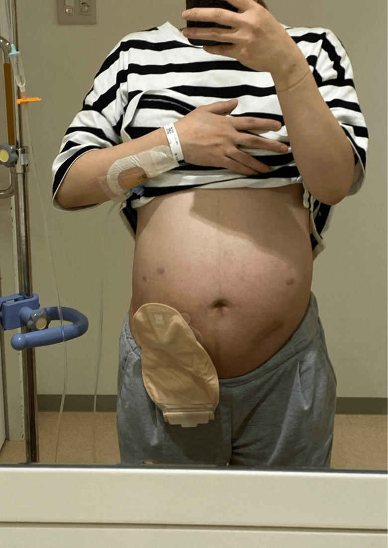 帝王切開直前の様子